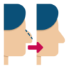 Rhinoplasty